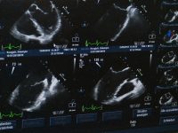 Ayrıntılı Ultrason Ne Zaman Yapılır |  Hamilelikte detaylı ultrason gerekli mi?