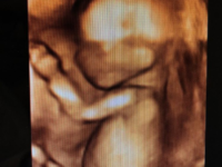 Gebelik Ultrason Görüntüleri | Hamilelik Ultrason Görüntüsü