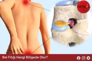 Bel Fıtığı Hangi Bölgede Olur