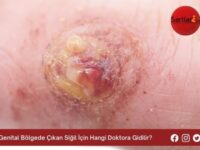 Genital Bölgede Çıkan Siğil İçin Hangi Doktora Gidilir