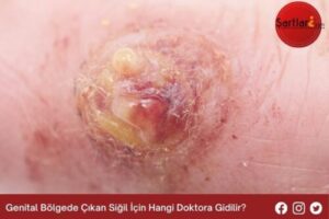 Genital Bölgede Çıkan Siğil İçin Hangi Doktora Gidilir