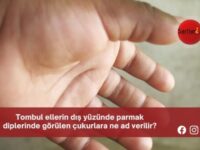 Tombul ellerin dış yüzünde parmak diplerinde görülen çukurlara ne ad verilir?