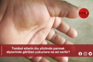 Tombul ellerin dış yüzünde parmak diplerinde görülen çukurlara ne ad verilir?