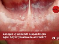 Yanağın iç kısmında oluşan küçük ağrılı beyaz yaralara ne ad verilir?