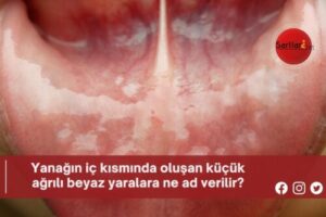 Yanağın iç kısmında oluşan küçük ağrılı beyaz yaralara ne ad verilir?